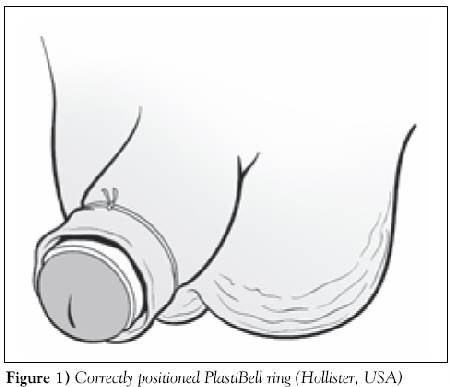 orrectly positioned PlastiBell ring