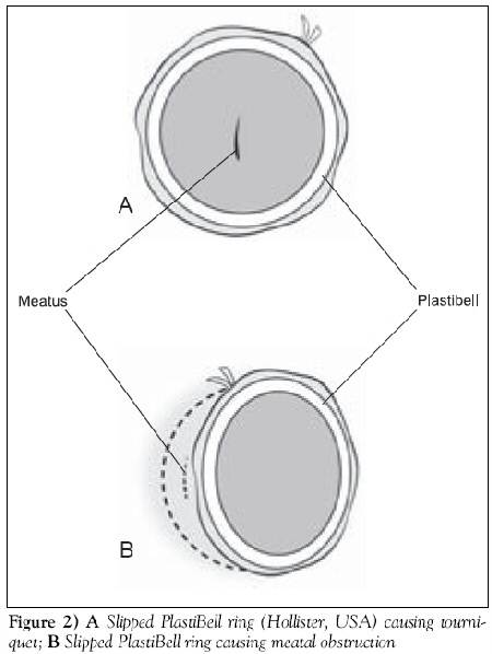 Slipped PlastiBell ring causing a) tourniquet, b) meatal obstruction