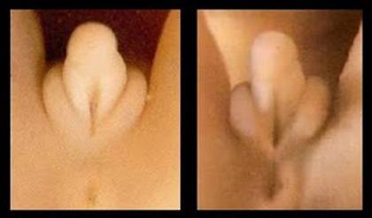 Klitoris beschnittene Schamlippen langziehen.