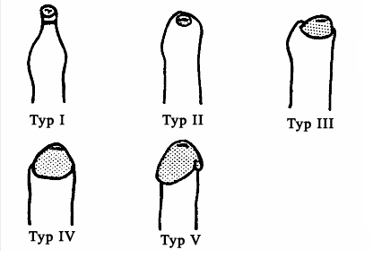 Kayabas Vorhautypen