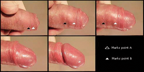 Wie sieht ein beschnittener penis aus
